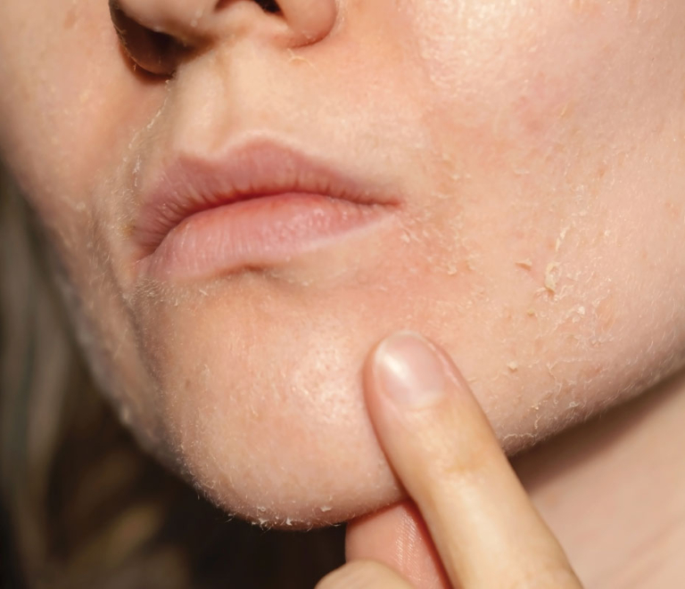 How Do I Fix Dry Skin Or Skin That Is Dehydrated?