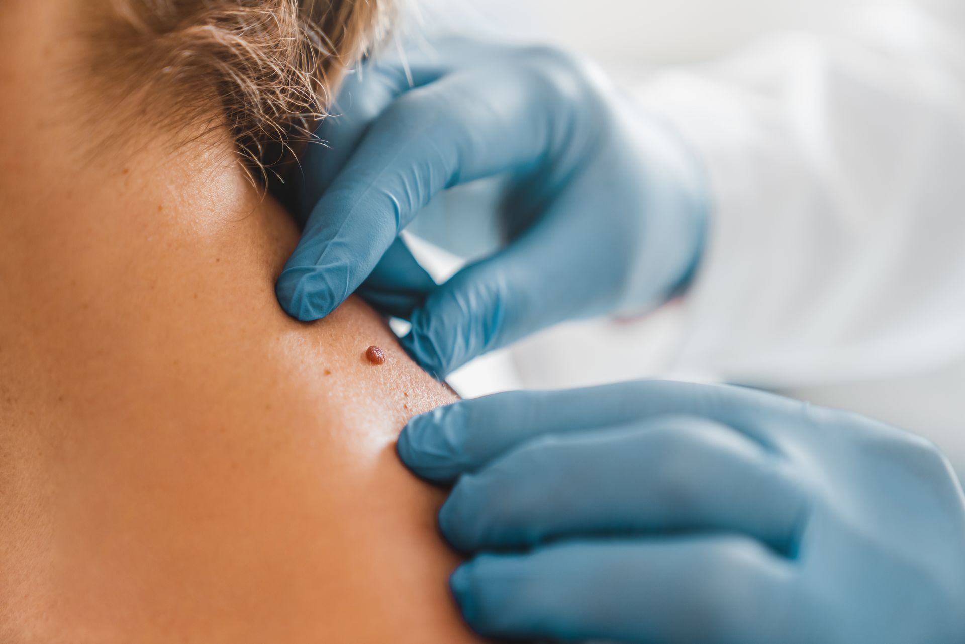 Mole Removal Belgravia | Montrose Dermatologists London