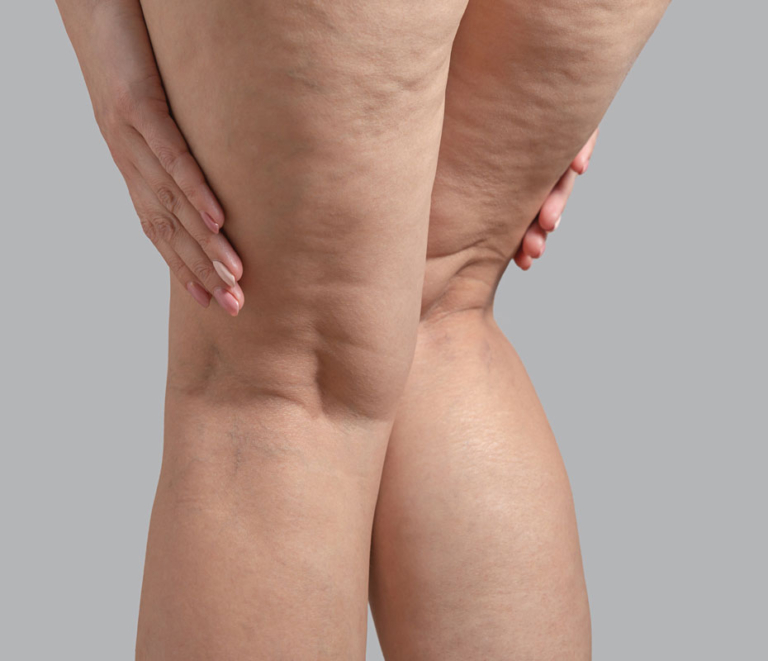 Can You Get Rid of Cellulite?