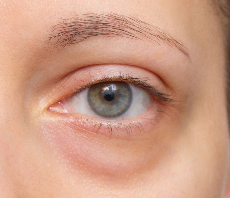 What Are Effective Treatments for Bags Under Eyes?