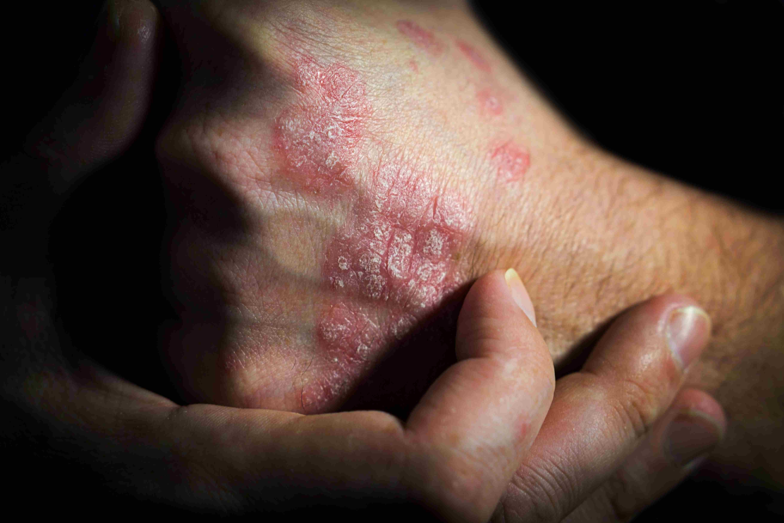 Dermatology psoriasis skin condition itchy skin