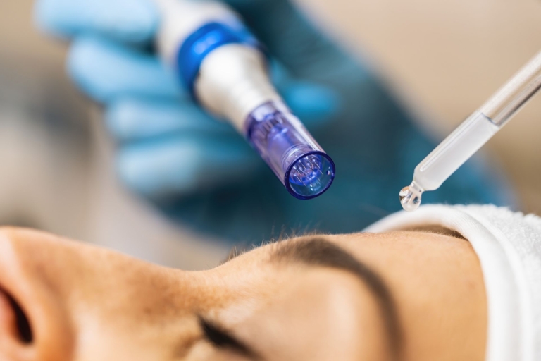 SkinPen Microneedling