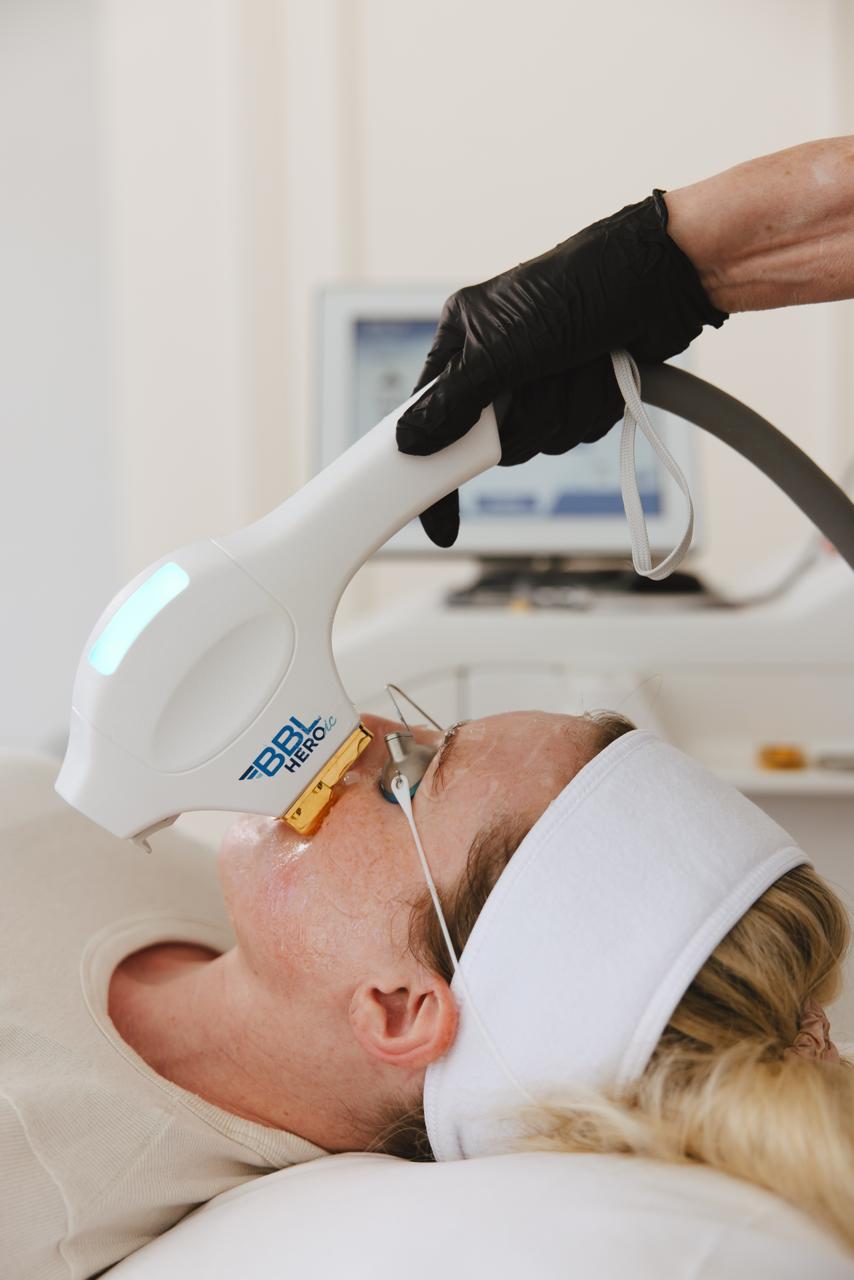 Sciton BBL treatment being performed on a young blonde woman's face.