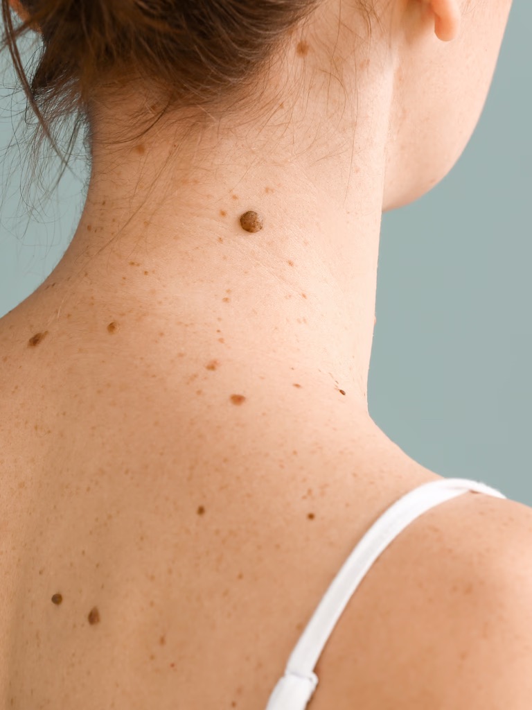 What Is the Best Clinic for Early Skin Cancer Detection in London?
