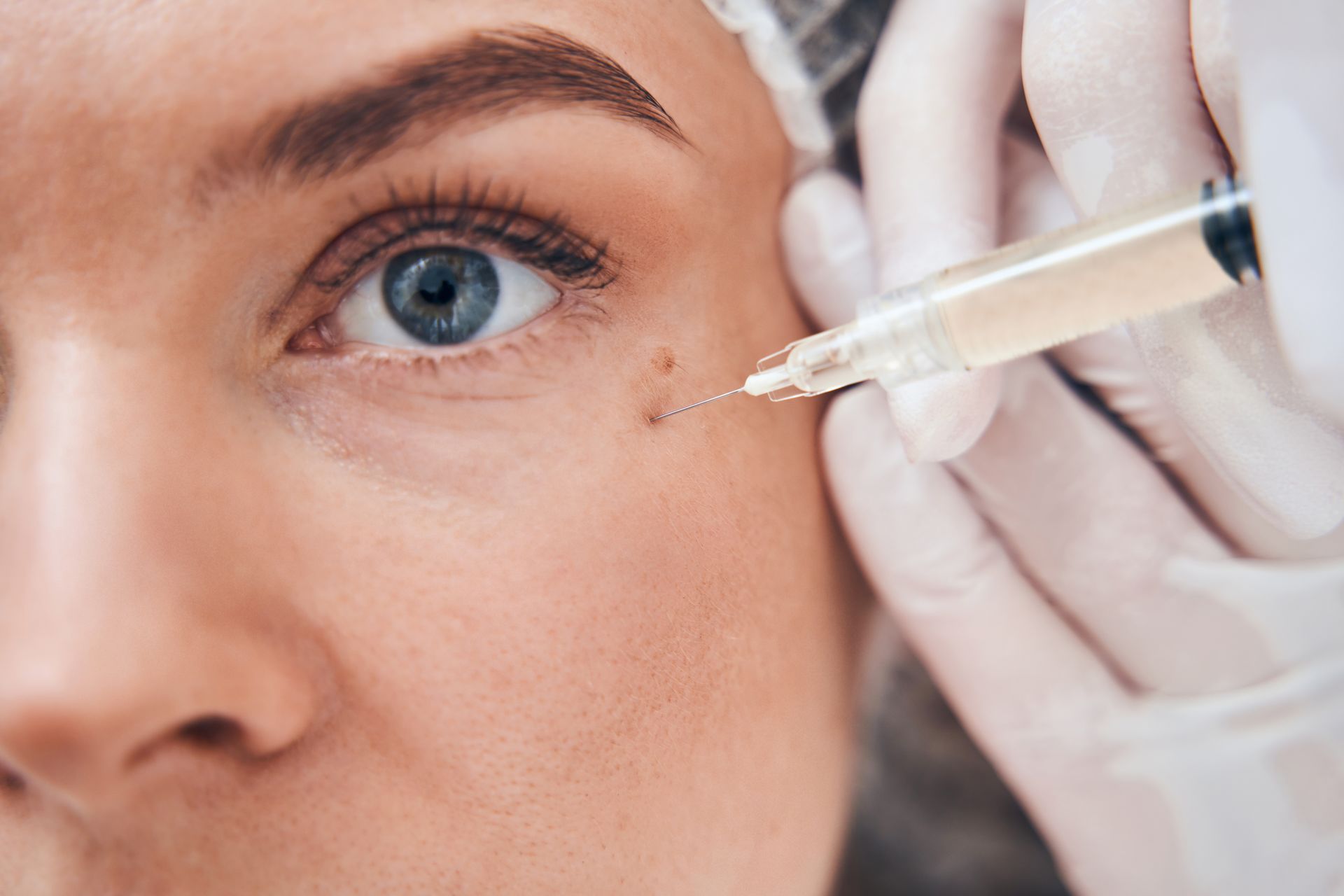 Tear trough filler under-eye treatment at Montrose London Belgravia
